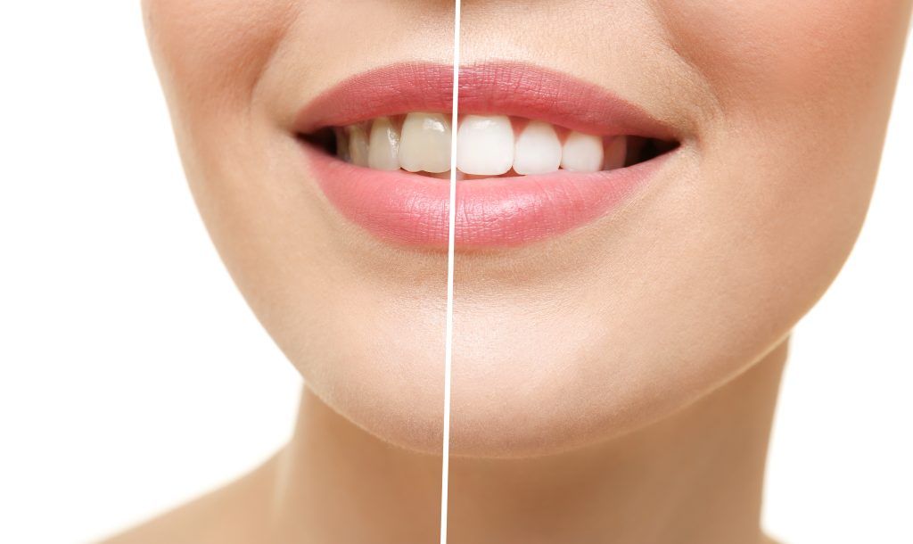 Cómo conseguir una sonrisa blanca en Clínica Dental P6 en Madrid Sur